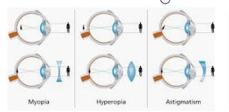 presbyopia correction