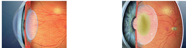 get cataract surgery