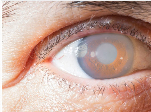 what is cataract singapore