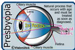 presbyopia cataract Singapore